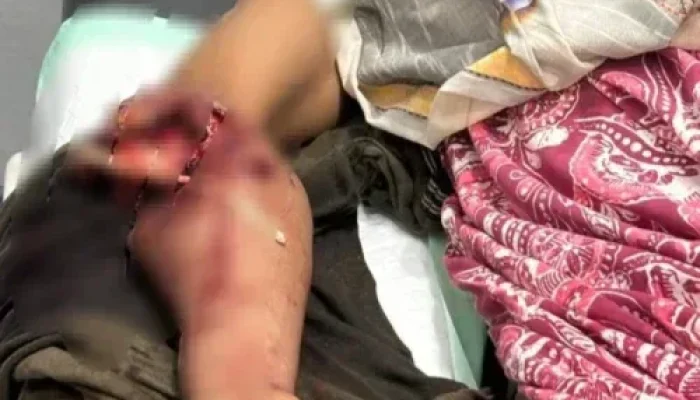 Diserang Buaya di Sungai Rokan, Warga Ujung Tanjung Kehilangan Tangan