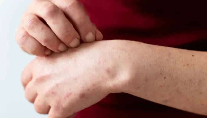 Waspada Lonjakan Campak 2026, Kemenkes Perketat Protokol di Fasilitas Kesehatan