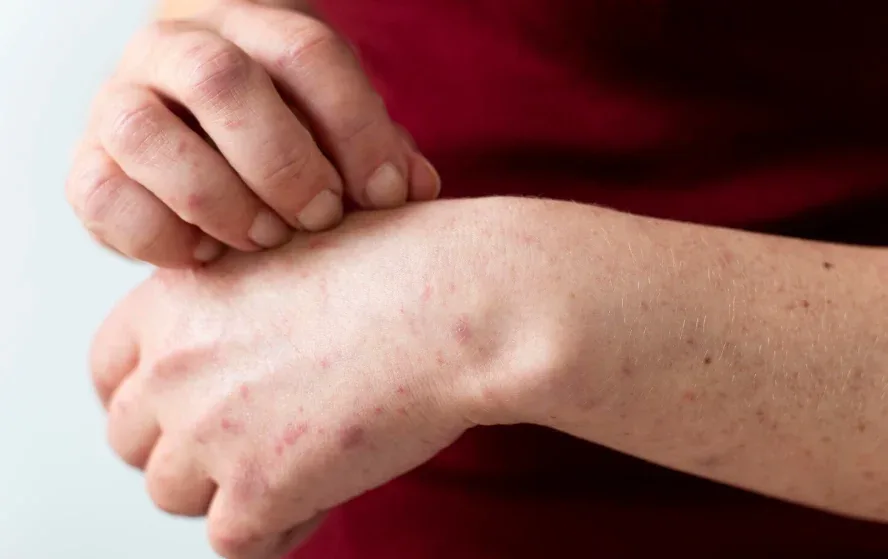 Waspada Lonjakan Campak 2026, Kemenkes Perketat Protokol di Fasilitas Kesehatan